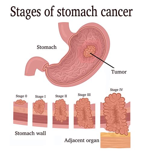 gastrointestinal cancer near hayward|Oncologists, Cancer Doctors near me in Hayward, CA .